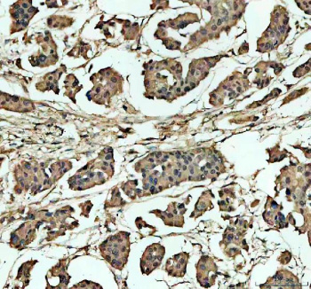 Immunohistochemical staining of NCOR2 using anti-NCOR2 antibody. NCOR2 was detected in a paraffin-embedded section of human breast cancer tissue. Heat mediated antigen retrieval was performed in EDTA buffer (pH 8.0, epitope retrieval solution). The tissue section was blocked with 10% goat serum. The tissue section was then incubated with 2 ug/ml rabbit anti-NCOR2 antibody overnight at 4oC. Peroxidase Conjugated Goat Anti-rabbit IgG was used as secondary antibody and incubated for 30 minutes at 37oC. The tissue section was developed using an HRP secondary and DAB substrate.