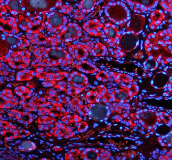 Immunofluorescent staining of FFPE human thyroid cancer tissue with SHMT2 antibody (red) and DAPI nuclear stain (blue). HIER: steam section in pH8 EDTA buffer for 20 min.