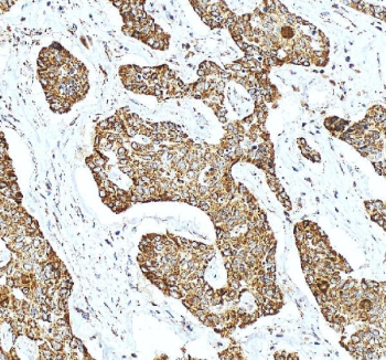 Immunohistochemical staining of SHMT2 using anti-SHMT2 antibody. SHMT2 was detected in a paraffin-embedded section of human liver cancer tissue. Heat mediated antigen retrieval was performed in EDTA buffer (pH 8.0, epitope retrieval solution). The tissue section was blocked with 10% goat serum. The tissue section was then incubated with 2 ug/ml rabbit anti-SHMT2 antibody overnight at 4oC. Peroxidase Conjugated Goat Anti-rabbit IgG was used as secondary antibody and incubated for 30 minutes at 37oC. The tissue section was developed using an HRP secondary and DAB substrate.