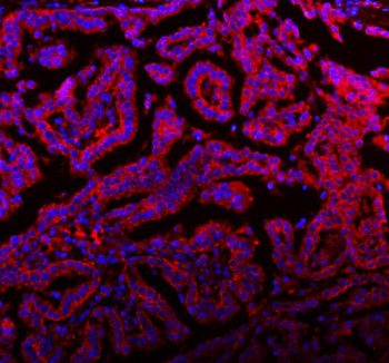 Immunofluorescent staining of FFPE human lung cancer tissue with MALSU1 antibody (red) and DAPI nuclear stain (blue). HIER: steam section in pH8 EDTA buffer for 20 min.