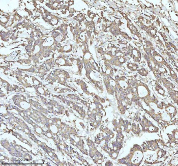 Immunohistochemical staining of MALSU1 using anti-MALSU1 antibody. MALSU1 was detected in a paraffin-embedded section of human colon adenocarcinoma tissue. Heat mediated antigen retrieval was performed in EDTA buffer (pH 8.0, epitope retrieval solution). The tissue section was blocked with 10% goat serum. The tissue section was then incubated with 2 ug/ml rabbit anti-MALSU1 antibody overnight at 4oC. Peroxidase Conjugated Goat Anti-rabbit IgG was used as secondary antibody and incubated for 30 minutes at 37oC. The tissue section was developed using an HRP secondary and DAB substrate.