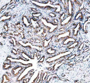 TGOLN2 Antibody Human Colon Cancer IHC. Immunohistochemical staining of FFPE human colon cancer tissue using TGOLN2 Antibody. HIER was performed using pH 8 EDTA buffer, and sections were blocked with goat serum prior to staining. The tissue was incubated with rabbit anti-TGOLN2 antibody at 2 ug/ml overnight at 4Â°C. An HRP-conjugated goat anti-rabbit IgG secondary antibody with DAB substrate was used for detection. This TGOLN2 Antibody demonstrates TGOLN2 expression within colon cancer tissue, supporting studies of trans-Golgi network function, intracellular vesicle trafficking, protein sorting, and secretory pathway regulation.
