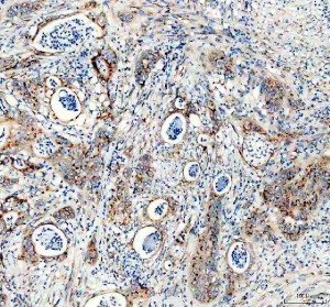 TGOLN2 Antibody Human Colon Cancer IHC. Immunohistochemical staining of FFPE human colon cancer tissue using TGOLN2 Antibody. HIER was performed using pH 8 EDTA buffer, and sections were blocked with goat serum prior to staining. The tissue was incubated with rabbit anti-TGOLN2 antibody at 2 ug/ml overnight at 4Â°C. An HRP-conjugated goat anti-rabbit IgG secondary antibody with DAB substrate was used for detection. This TGOLN2 Antibody demonstrates TGOLN2 expression in colon tumor cells and stromal-associated regions, supporting studies of trans-Golgi network organization, protein trafficking, vesicle transport, and regulation of secretory pathway function.