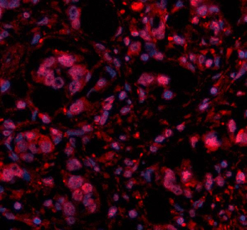 Histone H4 Antibody Breast Cancer IF. Immunofluorescence analysis of FFPE human breast cancer tissue using Histone H4 antibody. Histone H4 staining (red) demonstrates strong nuclear localization within tumor epithelial cells, consistent with the chromatin-associated distribution of HIST1H4 family proteins and nucleosome core components involved in epigenetic regulation and nuclear organization. Nuclei are counterstained blue with DAPI. Heat-mediated antigen retrieval was performed in pH8 EDTA buffer prior to staining. The observed widespread nuclear signal pattern aligns with the essential role of Histone H4 in chromatin structure maintenance within proliferative tumor tissue.