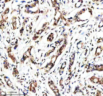 Histone H4 Antibody Breast Cancer IHC. Immunohistochemistry analysis of FFPE human breast cancer tissue using Histone H4 antibody. Tumor epithelial cells demonstrate strong HRP-DAB brown nuclear staining consistent with the chromatin-associated localization of Histone H4 and HIST1H4 family proteins within nucleosome core complexes. The staining pattern shows prominent nuclear compartmentalization with minimal cytoplasmic signal, aligning with the essential role of Histone H4 in chromatin organization, DNA packaging, and epigenetic regulation. Nuclei are counterstained blue.