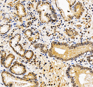 NUP50 Antibody by IHC in Human Stomach Cancer Tissue. Immunohistochemistry staining of FFPE human stomach cancer tissue using rabbit polyclonal NUP50 antibody at 2 ug/ml. Heat-induced epitope retrieval was performed using EDTA buffer (pH 8.0), followed by blocking with 10% goat serum and overnight primary antibody incubation at 4oC. Brown immunoreactivity is observed in malignant glandular epithelial cells, with staining involving nuclear and cytoplasmic compartments. The surrounding stromal tissue exhibits comparatively weaker staining.