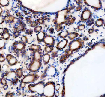 Immunohistochemical staining of TMED1 using anti-TMED1 antibody. TMED1 was detected in a paraffin-embedded section of human thyroid cancer tissue. Heat mediated antigen retrieval was performed in EDTA buffer (pH 8.0, epitope retrieval solution). The tissue section was blocked with 10% goat serum. The tissue section was then incubated with 2 ug/ml rabbit anti-TMED1 antibody overnight at 4oC. Peroxidase Conjugated Goat Anti-rabbit IgG was used as secondary antibody and incubated for 30 minutes at 37oC. The tissue section was developed using an HRP secondary and DAB substrate.