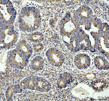 Immunohistochemical staining of OMA1 using anti-OMA1 antibody. OMA1 was detected in a paraffin-embedded section of human colon cancer tissue. Heat mediated antigen retrieval was performed in EDTA buffer (pH 8.0, epitope retrieval solution). The tissue section was blocked with 10% goat serum. The tissue section was then incubated with 2 ug/ml rabbit anti-OMA1 antibody overnight at 4oC. Peroxidase Conjugated Goat Anti-rabbit IgG was used as secondary antibody and incubated for 30 minutes at 37oC. The tissue section was developed using an HRP secondary and DAB substrate.