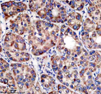 Immunohistochemical staining of TRIM59 using anti-TRIM59 antibody. TRIM59 was detected in a paraffin-embedded section of human liver cancer tissue. Heat mediated antigen retrieval was performed in EDTA buffer (pH 8.0, epitope retrieval solution). The tissue section was blocked with 10% goat serum. The tissue section was then incubated with 2 ug/ml rabbit anti-TRIM59 antibody overnight at 4oC. Peroxidase Conjugated Goat Anti-rabbit IgG was used as secondary antibody and incubated for 30 minutes at 37oC. The tissue section was developed using an HRP secondary and DAB substrate.