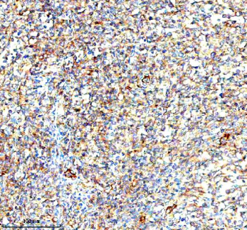 Immunohistochemical staining of IVNS1ABP using anti-IVNS1ABP antibody. IVNS1ABP was detected in a paraffin-embedded section of human lymphoma tissue. Heat mediated antigen retrieval was performed in EDTA buffer (pH 8.0, epitope retrieval solution). The tissue section was blocked with 10% goat serum. The tissue section was then incubated with 2 ug/ml rabbit anti-IVNS1ABP antibody overnight at 4oC. Peroxidase Conjugated Goat Anti-rabbit IgG was used as secondary antibody and incubated for 30 minutes at 37oC. The tissue section was developed using an HRP secondary and DAB substrate.