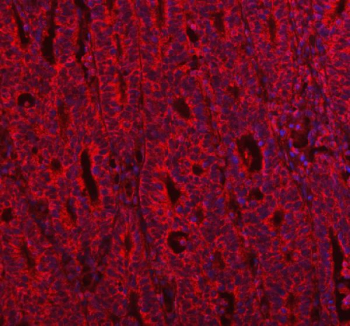 Immunofluorescent staining of IVNS1ABP using anti-IVNS1ABP antibody (red). IVNS1ABP was detected in a paraffin-embedded section of human colon cancer tissue. Heat mediated antigen retrieval was performed in EDTA buffer (pH 8.0, epitope retrieval solution). The tissue section was blocked with 10% goat serum. The tissue section was then incubated with 5 ug/ml rabbit anti-IVNS1ABP antibody overnight at 4oC. Biotin conjugated goat anti-rabbit IgG was used as secondary antibody and incubated for 30 minutes at 37oC. The tissue section was developed using Cy3-conjugated Anti-rabbit IgG Secondary antibody (red). The section was counterstained with DAPI nuclear stain (blue). Visualize using a fluorescence microscope and filter sets appropriate for the label used.