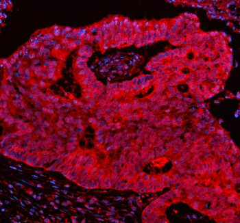 Immunofluorescent staining of ERCC5 using anti-ERCC5 antibody (red). ERCC5 was detected in a paraffin-embedded section of human colon cancer tissue. Heat mediated antigen retrieval was performed in EDTA buffer (pH 8.0, epitope retrieval solution). The tissue section was blocked with 10% goat serum. The tissue section was then incubated with 5 ug/ml rabbit anti-ERCC5 antibody overnight at 4oC. Cy3 Conjugated Goat Anti-Rabbit IgG was used as secondary antibody at 1:500 dilution and incubated for 30 minutes at 37oC. The section was counterstained with DAPI nuclear stain (blue). Visualize using a fluorescence microscope and filter sets appropriate for the label used.