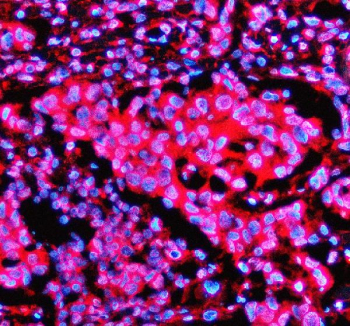 Immunofluorescent staining of STX5 using anti-STX5 antibody (red). STX5 was detected in a paraffin-embedded section of human breast cancer tissue. Heat mediated antigen retrieval was performed in EDTA buffer (pH 8.0, epitope retrieval solution). The tissue section was blocked with 10% goat serum. The tissue section was then incubated with 5 ug/ml rabbit anti-STX5 antibody overnight at 4oC. Cy3 Conjugated Goat Anti-Rabbit IgG was used as secondary antibody at 1:500 dilution and incubated for 30 minutes at 37oC. The section was counterstained with DAPI nuclear stain (blue). Visualize using a fluorescence microscope and filter sets appropriate for the label used.