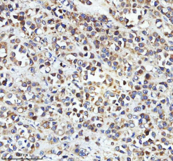 Immunohistochemical staining of STRIP2 using anti-STRIP2 antibody. STRIP2 was detected in a paraffin-embedded section of human breast cancer tissue. Heat mediated antigen retrieval was performed in EDTA buffer (pH 8.0, epitope retrieval solution). The tissue section was blocked with 10% goat serum. The tissue section was then incubated with 2 ug/ml rabbit anti-STRIP2 antibody overnight at 4oC. Peroxidase Conjugated Goat Anti-rabbit IgG was used as secondary antibody and incubated for 30 minutes at 37oC. The tissue section was developed using an HRP secondary and DAB substrate.