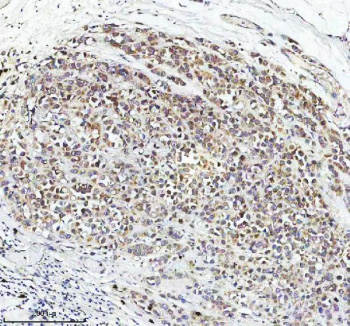 Immunohistochemical staining of STRIP2 using anti-STRIP2 antibody. STRIP2 was detected in a paraffin-embedded section of human breast cancer tissue. Heat mediated antigen retrieval was performed in EDTA buffer (pH 8.0, epitope retrieval solution). The tissue section was blocked with 10% goat serum. The tissue section was then incubated with 2 ug/ml rabbit anti-STRIP2 antibody overnight at 4oC. Peroxidase Conjugated Goat Anti-rabbit IgG was used as secondary antibody and incubated for 30 minutes at 37oC. The tissue section was developed using an HRP secondary and DAB substrate.