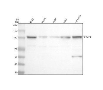 Western blot analysis of STRIP2 using anti-STRIP2 antibody. Lane 1: human K562 whole cell lysates, Lane 2: human Hacat whole cell lysates, Lane 3: human whole cell lysates, Lane 4: human SiHa whole cell lysates, Lane 5: rat testis tissue lysates. After electrophoresis, proteins were transferred to a nitrocellulose membrane at 150 mA for 50-90 minutes. Blocked the membrane with 5% non-fat milk/TBS for 1.5 hour at RT. The membrane was incubated with rabbit anti-STRIP2 antibody at 0.5 ug/ml overnight at 4oC, then washed with TBS-0.1%Tween 3 times with 5 minutes each and probed with a goat anti-rabbit IgG-HRP secondary antibody at a dilution of 1:5000 for 1.5 hour at RT. The signal was developed using enhanced chemiluminescent. Immunohistochemical staining of STRIP2 using anti-STRIP2 antibody. STRIP2 was detected in a paraffin-embedded section of human breast cancer tissue. Heat mediated antigen retrieval was performed in EDTA buffer (pH 8.0, epitope retrieval solution). The tissue section was blocked with 10% goat serum. The tissue section was then incubated with 2 ug/ml rabbit anti-STRIP2 antibody overnight at 4oC. Peroxidase Conjugated Goat Anti-rabbit IgG was used as secondary antibody and incubated for 30 minutes at 37oC. The tissue section was developed using an HRP secondary and DAB substrate. STRIP2 (~95 kDa predicted) was detected as a major band at ~100 kDa, often appearing as a doublet consistent with phosphorylation-dependent mobility differences characteristic of STRIPAK complex proteins.