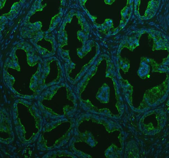 Immunofluorescent staining of BCAP31 using anti-BCAP31 antibody (green). BCAP31 was detected in a paraffin-embedded section of human prostate cancer tissue. Heat mediated antigen retrieval was performed in EDTA buffer (pH 8.0, epitope retrieval solution). The tissue section was blocked with 10% goat serum. The tissue section was then incubated with 5 ug/ml rabbit anti-BCAP31 antibody overnight at 4oC. DyLight 488 Conjugated Goat Anti-Rabbit IgG was used as secondary antibody at 1:500 dilution and incubated for 30 minutes at 37oC. The section was counterstained with DAPI nuclear stain (blue). Visualize using a fluorescence microscope and filter sets appropriate for the label used.