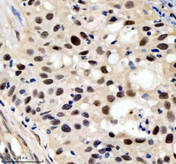 Immunohistochemical staining of SIN3B using anti-SIN3B antibody. SIN3B was detected in a paraffin-embedded section of human bladder cancer tissue. Heat mediated antigen retrieval was performed in EDTA buffer (pH 8.0, epitope retrieval solution). The tissue section was blocked with 10% goat serum. The tissue section was then incubated with 2 ug/ml rabbit anti-SIN3B antibody overnight at 4oC. Peroxidase Conjugated Goat Anti-rabbit IgG was used as secondary antibody and incubated for 30 minutes at 37oC. The tissue section was developed using an HRP secondary and DAB substrate.