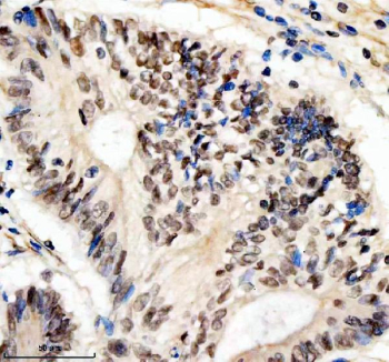 Immunohistochemical staining of SIN3B using anti-SIN3B antibody. SIN3B was detected in a paraffin-embedded section of human colon cancer tissue. Heat mediated antigen retrieval was performed in EDTA buffer (pH 8.0, epitope retrieval solution). The tissue section was blocked with 10% goat serum. The tissue section was then incubated with 2 ug/ml rabbit anti-SIN3B antibody overnight at 4oC. Peroxidase Conjugated Goat Anti-rabbit IgG was used as secondary antibody and incubated for 30 minutes at 37oC. The tissue section was developed using an HRP secondary and DAB substrate.