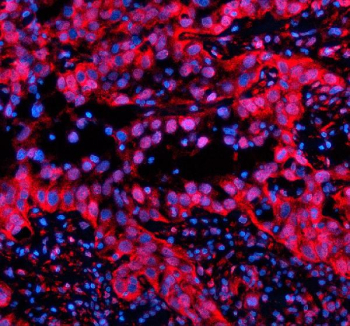 Immunofluorescent staining of SIN3B using anti-SIN3B antibody (red). SIN3B was detected in a paraffin-embedded section of human bladder cancer tissue. Heat mediated antigen retrieval was performed in EDTA buffer (pH 8.0, epitope retrieval solution). The tissue section was blocked with 10% goat serum. The tissue section was then incubated with 5 ug/ml rabbit anti-SIN3B antibody overnight at 4oC. Cy3 Conjugated Goat Anti-Rabbit IgG was used as secondary antibody at 1:500 dilution and incubated for 30 minutes at 37oC. The section was counterstained with DAPI nuclear stain (blue). Visualize using a fluorescence microscope and filter sets appropriate for the label used.