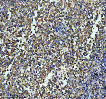 Immunohistochemical staining of ITGB7 using anti-ITGB7 antibody. ITGB7 was detected in a paraffin-embedded section of human lymphoma tissue. Heat mediated antigen retrieval was performed in EDTA buffer (pH 8.0, epitope retrieval solution). The tissue section was blocked with 10% goat serum. The tissue section was then incubated with 1:50 rabbit anti-ITGB7 antibody overnight at 4oC. Peroxidase Conjugated Goat Anti-rabbit IgG was used as secondary antibody and incubated for 30 minutes at 37oC. The tissue section was developed using an HRP secondary and DAB substrate.