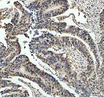 Immunohistochemical staining of RB1 using anti-RB1 antibody. RB1 was detected in a paraffin-embedded section of human colon cancer tissue. Heat mediated antigen retrieval was performed in EDTA buffer (pH 8.0, epitope retrieval solution). The tissue section was blocked with 10% goat serum. The tissue section was then incubated with 2 ug/ml rabbit anti-RB1 antibody overnight at 4oC. Peroxidase Conjugated Goat Anti-rabbit IgG was used as secondary antibody and incubated for 30 minutes at 37oC. The tissue section was developed using an HRP secondary and DAB substrate.
