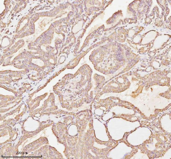 Immunohistochemical staining of MICALL1 using anti-MICALL1 antibody. MICALL1 was detected in a paraffin-embedded section of human thyroid papillary carcinoma tissue. Heat mediated antigen retrieval was performed in EDTA buffer (pH 8.0, epitope retrieval solution). The tissue section was blocked with 10% goat serum. The tissue section was then incubated with 2 ug/ml rabbit anti-MICALL1 antibody overnight at 4oC. Peroxidase Conjugated Goat Anti-rabbit IgG was used as secondary antibody and incubated for 30 minutes at 37oC. The tissue section was developed using an HRP secondary and DAB substrate.