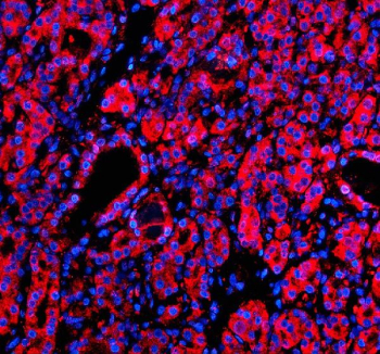 Immunofluorescent staining of MSI2 using anti-MSI2 antibody (red). MSI2 was detected in a paraffin-embedded section of human thyroid cancer tissue. Heat mediated antigen retrieval was performed in EDTA buffer (pH 8.0, epitope retrieval solution). The tissue section was blocked with 10% goat serum. The tissue section was then incubated with 5 ug/ml rabbit anti-MSI2 antibody overnight at 4oC. Cy3 Conjugated Goat Anti-Rabbit IgG was used as secondary antibody at 1:500 dilution and incubated for 30 minutes at 37oC. The section was counterstained with DAPI nuclear stain (blue). Visualize using a fluorescence microscope and filter sets appropriate for the label used.