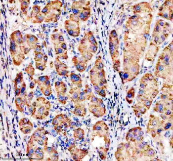 Immunohistochemical staining of MFSD2A using anti-MFSD2A antibody. MFSD2A was detected in a paraffin-embedded section of human liver cancer tissue. Heat mediated antigen retrieval was performed in EDTA buffer (pH 8.0, epitope retrieval solution). The tissue section was blocked with 10% goat serum. The tissue section was then incubated with 2 ug/ml rabbit anti-MFSD2A antibody overnight at 4oC. Peroxidase Conjugated Goat Anti-rabbit IgG was used as secondary antibody and incubated for 30 minutes at 37oC. The tissue section was developed using an HRP secondary and DAB substrate.