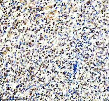 Immunohistochemical staining of TERF2IP using anti-TERF2IP antibody. TERF2IP was detected in a paraffin-embedded section of human lymphoma tissue. Heat mediated antigen retrieval was performed in EDTA buffer (pH 8.0, epitope retrieval solution). The tissue section was blocked with 10% goat serum. The tissue section was then incubated with 2 ug/ml rabbit anti-TERF2IP antibody overnight at 4oC. Peroxidase Conjugated Goat Anti-rabbit IgG was used as secondary antibody and incubated for 30 minutes at 37oC. The tissue section was developed using an HRP secondary and DAB substrate.