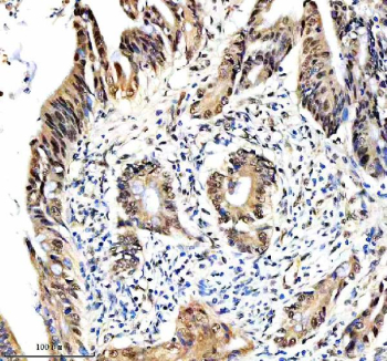 Immunohistochemical staining of RTRAF using anti-RTRAF antibody. RTRAF was detected in a paraffin-embedded section of human colon cancer tissue. Heat mediated antigen retrieval was performed in EDTA buffer (pH 8.0, epitope retrieval solution). The tissue section was blocked with 10% goat serum. The tissue section was then incubated with 2 ug/ml rabbit anti-RTRAF antibody overnight at 4oC. Peroxidase Conjugated Goat Anti-rabbit IgG was used as secondary antibody and incubated for 30 minutes at 37oC. The tissue section was developed using an HRP secondary and DAB substrate.