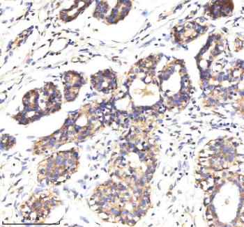 Immunohistochemical staining of MARVELD2 using anti-MARVELD2 antibody. MARVELD2 was detected in a paraffin-embedded section of human breast cancer tissue. Heat mediated antigen retrieval was performed in EDTA buffer (pH 8.0, epitope retrieval solution). The tissue section was blocked with 10% goat serum. The tissue section was then incubated with 2 ug/ml rabbit anti-MARVELD2 antibody overnight at 4oC. Peroxidase Conjugated Goat Anti-rabbit IgG was used as secondary antibody and incubated for 30 minutes at 37oC. The tissue section was developed using an HRP secondary and DAB substrate.