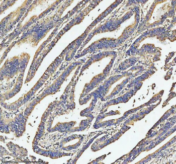 Immunohistochemical staining of SOS1 using anti-SOS1 antibody. SOS1 was detected in a paraffin-embedded section of human colon cancer tissue. Heat mediated antigen retrieval was performed in EDTA buffer (pH 8.0, epitope retrieval solution). The tissue section was blocked with 10% goat serum. The tissue section was then incubated with 2 ug/ml rabbit anti-SOS1 antibody overnight at 4oC. Peroxidase Conjugated Goat Anti-rabbit IgG was used as secondary antibody and incubated for 30 minutes at 37oC. The tissue section was developed using an HRP secondary and DAB substrate.