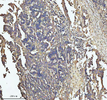 Immunohistochemical staining of SOS1 using anti-SOS1 antibody. SOS1 was detected in a paraffin-embedded section of human colon cancer tissue. Heat mediated antigen retrieval was performed in EDTA buffer (pH 8.0, epitope retrieval solution). The tissue section was blocked with 10% goat serum. The tissue section was then incubated with 2 ug/ml rabbit anti-SOS1 antibody overnight at 4oC. Peroxidase Conjugated Goat Anti-rabbit IgG was used as secondary antibody and incubated for 30 minutes at 37oC. The tissue section was developed using an HRP secondary and DAB substrate.