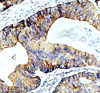 Immunohistochemical staining of SLIRP using anti-SLIRP antibody. SLIRP was detected in a paraffin-embedded section of human colon cancer tissue. Heat mediated antigen retrieval was performed in EDTA buffer (pH 8.0, epitope retrieval solution). The tissue section was blocked with 10% goat serum. The tissue section was then incubated with 2 ug/ml rabbit anti-SLIRP antibody overnight at 4oC. Peroxidase Conjugated Goat Anti-rabbit IgG was used as secondary antibody and incubated for 30 minutes at 37oC. The tissue section was developed using an HRP secondary and DAB substrate.