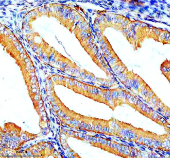 Immunohistochemical staining of ZIP8/SLC39A8 using anti-SLC39A8 antibody. ZIP8/SLC39A8 was detected in a paraffin-embedded section of human endometrial cancer tissue. Heat mediated antigen retrieval was performed in EDTA buffer (pH 8.0, epitope retrieval solution). The tissue section was blocked with 10% goat serum. The tissue section was then incubated with 2 ug/ml rabbit anti-SLC39A8 antibody overnight at 4oC. Peroxidase Conjugated Goat Anti-rabbit IgG was used as secondary antibody and incubated for 30 minutes at 37oC. The tissue section was developed using an HRP secondary and DAB substrate.