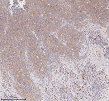 Immunohistochemical staining of SCAMP3 using anti-SCAMP3 antibody. SCAMP3 was detected in a paraffin-embedded section of human cervix squamous cell carcinoma tissue. Heat mediated antigen retrieval was performed in EDTA buffer (pH 8.0, epitope retrieval solution). The tissue section was blocked with 10% goat serum. The tissue section was then incubated with 2 ug/ml rabbit anti-SCAMP3 antibody overnight at 4oC. Peroxidase Conjugated Goat Anti-rabbit IgG was used as secondary antibody and incubated for 30 minutes at 37oC. The tissue section was developed using an HRP secondary and DAB substrate.