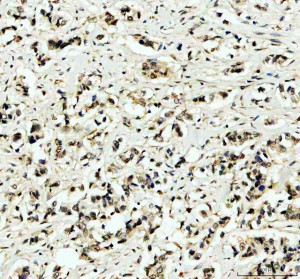 ITPKC Antibody by IHC in human breast cancer with fibrous stroma. Immunohistochemistry of FFPE human breast cancer tissue using ITPKC Antibody at 2 ug/ml. Irregularly distributed cells and small cellular clusters are visible within a fibrous stromal background. Brown immunoreactivity ranges from weak cytoplasmic staining to stronger labeling in scattered cells, while hematoxylin counterstains nuclei blue-purple. The heterogeneous distribution highlights ITPKC expression within the cellular components of the tissue. Heat-mediated antigen retrieval was performed using EDTA buffer at pH 8.0, followed by overnight primary antibody incubation at 4oC. This Inositol Trisphosphate 3-Kinase C Polyclonal Antibody demonstrates tissue immunoreactivity.