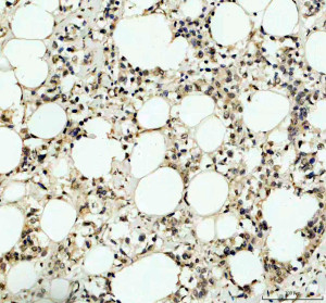ITPKC Antibody by IHC in human breast cancer with adipose tissue. Immunohistochemistry of FFPE human breast cancer tissue using ITPKC Antibody at 2 ug/ml. The section contains numerous adipocytes surrounded by cellular tissue exhibiting light-to-moderate brown immunoreactivity, with stronger staining in scattered cells. Adipocyte lipid vacuoles remain unstained, while hematoxylin highlights blue-purple nuclei. Staining is predominantly extranuclear, although precise localization is difficult to establish. Heat-mediated antigen retrieval was performed in EDTA buffer at pH 8.0, followed by overnight primary antibody incubation at 4oC. This Inositol Trisphosphate 3-Kinase C Polyclonal Antibody demonstrates immunoreactivity within the cellular component of the tissue.