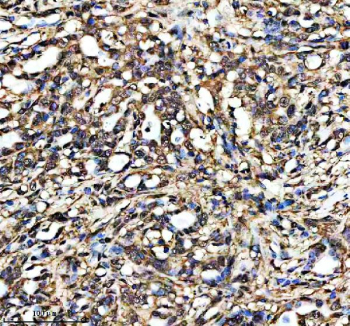 Phospho-CDK2/CDK1 Antibody Human Pancreatic Tumor IHC. Immunohistochemistry analysis of FFPE human pancreatic cancer tissue stained with phospho-CDK2/CDK1 antibody detecting CDK2 phosphorylated at Thr160 and CDK1 phosphorylated at Thr161, clone 31C95. Tumor epithelial cells show widespread nuclear and cytoplasmic HRP-DAB brown staining, consistent with elevated cell cycle activity and kinase activation, while surrounding stromal elements display lower staining intensity. Nuclei are counterstained blue. HIER: heat-mediated antigen retrieval in EDTA buffer (pH 8.0).