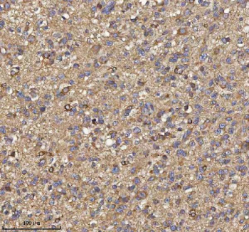 Immunohistochemical staining of TRIM2 using anti-TRIM2 antibody. TRIM2 was detected in a paraffin-embedded section of human glioblastoma tissue. Heat mediated antigen retrieval was performed in EDTA buffer (pH 8.0, epitope retrieval solution). The tissue section was blocked with 10% goat serum. The tissue section was then incubated with 2 ug/ml rabbit anti-TRIM2 antibody overnight at 4oC. Peroxidase Conjugated Goat Anti-rabbit IgG was used as secondary antibody and incubated for 30 minutes at 37oC. The tissue section was developed using an HRP secondary and DAB substrate.