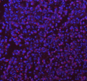 Immunohistochemical staining of SASS6 using anti-SASS6 antibody (red). SASS6 was detected in a paraffin-embedded section of human appendiceal carcinoid tissue. Heat mediated antigen retrieval was performed in EDTA buffer (pH 8.0, epitope retrieval solution). The tissue section was blocked with 10% goat serum. The tissue section was then incubated with 2 ug/ml rabbit anti-SASS6 antibody overnight at 4oC. Peroxidase Conjugated Goat Anti-rabbit IgG was used as secondary antibody and incubated for 30 minutes at 37oC. The tissue section was developed using an HRP secondary and DAB substrate.