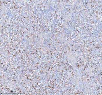 Immunohistochemical staining of SASS6 using anti-SASS6 antibody. SASS6 was detected in a paraffin-embedded section of human testicular seminoma tissue. Heat mediated antigen retrieval was performed in EDTA buffer (pH 8.0, epitope retrieval solution). The tissue section was blocked with 10% goat serum. The tissue section was then incubated with 2 ug/ml rabbit anti-SASS6 antibody overnight at 4oC. Peroxidase Conjugated Goat Anti-rabbit IgG was used as secondary antibody and incubated for 30 minutes at 37oC. The tissue section was developed using an HRP secondary and DAB substrate.