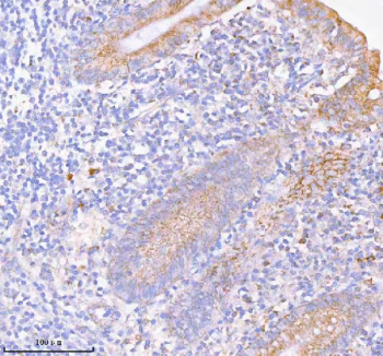 Immunohistochemical staining of SASS6 using anti-SASS6 antibody. SASS6 was detected in a paraffin-embedded section of human appendiceal carcinoid tissue. Heat mediated antigen retrieval was performed in EDTA buffer (pH 8.0, epitope retrieval solution). The tissue section was blocked with 10% goat serum. The tissue section was then incubated with 2 ug/ml rabbit anti-SASS6 antibody overnight at 4oC. Peroxidase Conjugated Goat Anti-rabbit IgG was used as secondary antibody and incubated for 30 minutes at 37oC. The tissue section was developed using an HRP secondary and DAB substrate.