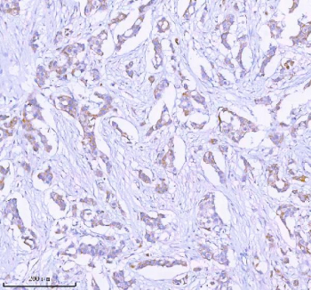 Immunohistochemical staining of SASS6 using anti-SASS6 antibody. SASS6 was detected in a paraffin-embedded section of human breast cancer tissue. Heat mediated antigen retrieval was performed in EDTA buffer (pH 8.0, epitope retrieval solution). The tissue section was blocked with 10% goat serum. The tissue section was then incubated with 2 ug/ml rabbit anti-SASS6 antibody overnight at 4oC. Peroxidase Conjugated Goat Anti-rabbit IgG was used as secondary antibody and incubated for 30 minutes at 37oC. The tissue section was developed using an HRP secondary and DAB substrate.