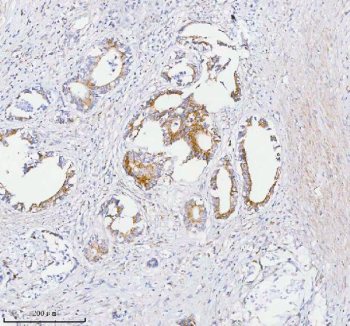 Immunohistochemical staining of SASS6 using anti-SASS6 antibody. SASS6 was detected in a paraffin-embedded section of human rectum adenocarcinoma tissue. Heat mediated antigen retrieval was performed in EDTA buffer (pH 8.0, epitope retrieval solution). The tissue section was blocked with 10% goat serum. The tissue section was then incubated with 2 ug/ml rabbit anti-SASS6 antibody overnight at 4oC. Peroxidase Conjugated Goat Anti-rabbit IgG was used as secondary antibody and incubated for 30 minutes at 37oC. The tissue section was developed using an HRP secondary and DAB substrate.
