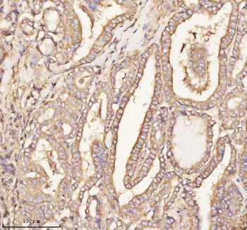Immunohistochemical staining of PTCD1 using anti-PTCD1 antibody. PTCD1 was detected in a paraffin-embedded section of human breast cancer tissue. Heat mediated antigen retrieval was performed in EDTA buffer (pH 8.0, epitope retrieval solution). The tissue section was blocked with 10% goat serum. The tissue section was then incubated with 2 ug/ml rabbit anti-PTCD1 antibody overnight at 4oC. Peroxidase Conjugated Goat Anti-rabbit IgG was used as secondary antibody and incubated for 30 minutes at 37oC. The tissue section was developed using an HRP secondary and DAB substrate.