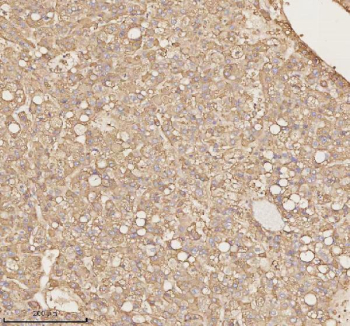 Immunohistochemical staining of PTCD1 using anti-PTCD1 antibody. PTCD1 was detected in a paraffin-embedded section of human liver cancer tissue. Heat mediated antigen retrieval was performed in EDTA buffer (pH 8.0, epitope retrieval solution). The tissue section was blocked with 10% goat serum. The tissue section was then incubated with 2 ug/ml rabbit anti-PTCD1 antibody overnight at 4oC. Peroxidase Conjugated Goat Anti-rabbit IgG was used as secondary antibody and incubated for 30 minutes at 37oC. The tissue section was developed using an HRP secondary and DAB substrate.