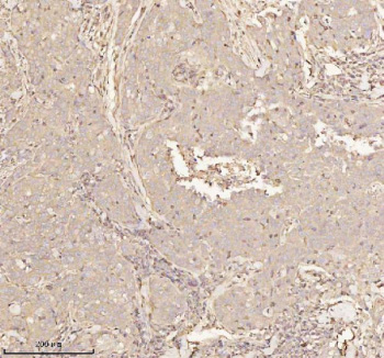 Immunohistochemical staining of PTCD1 using anti-PTCD1 antibody. PTCD1 was detected in a paraffin-embedded section of human thyroid papillary carcinoma tissue. Heat mediated antigen retrieval was performed in EDTA buffer (pH 8.0, epitope retrieval solution). The tissue section was blocked with 10% goat serum. The tissue section was then incubated with 2 ug/ml rabbit anti-PTCD1 antibody overnight at 4oC. Peroxidase Conjugated Goat Anti-rabbit IgG was used as secondary antibody and incubated for 30 minutes at 37oC. The tissue section was developed using an HRP secondary and DAB substrate.