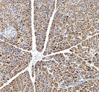 Immunohistochemical staining of OGFOD3 using anti-OGFOD3 antibody. OGFOD3 was detected in a paraffin-embedded section of human liver cancer tissue. Heat mediated antigen retrieval was performed in EDTA buffer (pH 8.0, epitope retrieval solution). The tissue section was blocked with 10% goat serum. The tissue section was then incubated with 2 ug/ml rabbit anti-OGFOD3 antibody overnight at 4oC. Peroxidase Conjugated Goat Anti-rabbit IgG was used as secondary antibody and incubated for 30 minutes at 37oC. The tissue section was developed using an HRP secondary and DAB substrate.